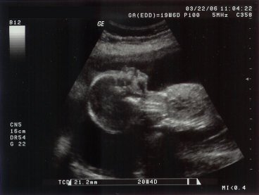 Ultrasound - profile view 2