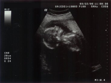 Ultrasound - profile view 1
